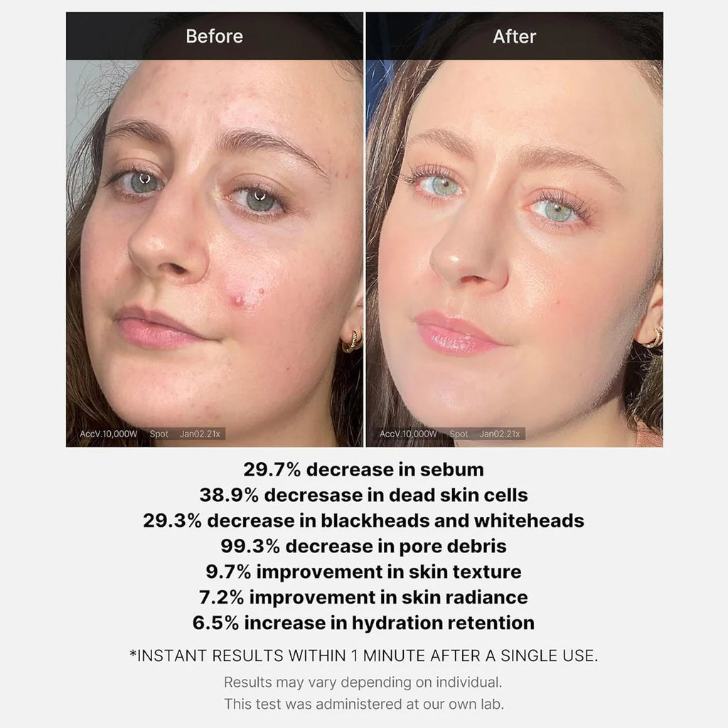 Medicube 1 Min Red Acne Succinic Acid Peel 40gm